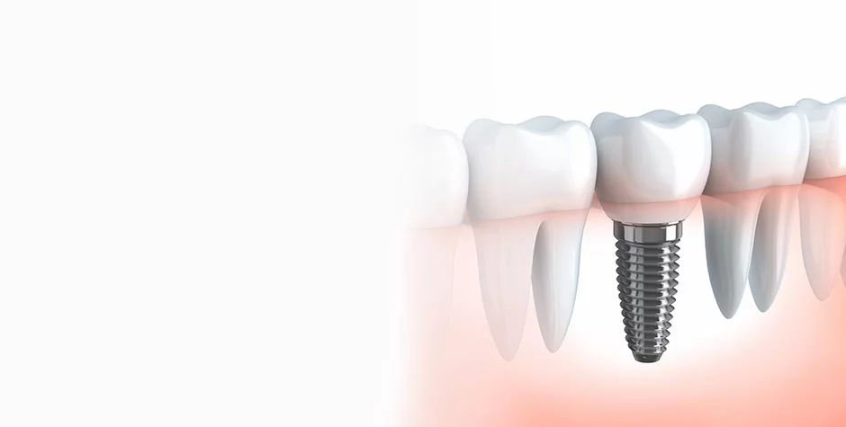 Implant Dentist Salt Lake