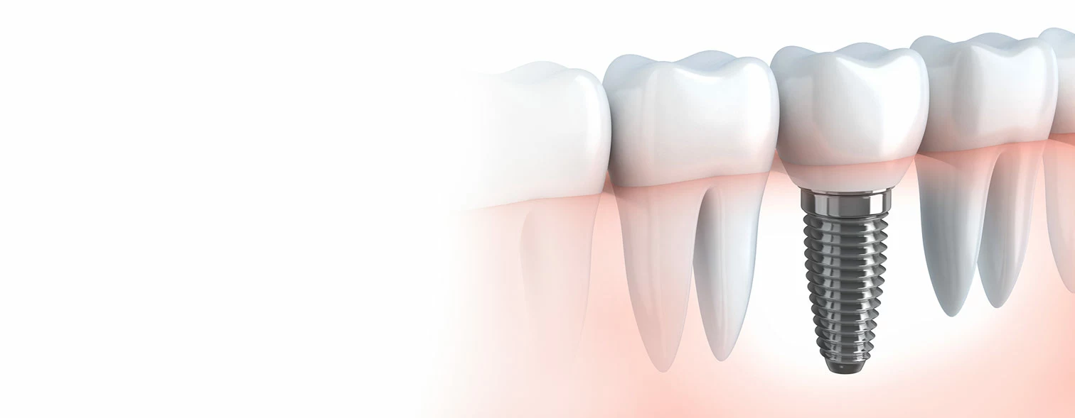 Ask Us About<br/>Implant Dentistry